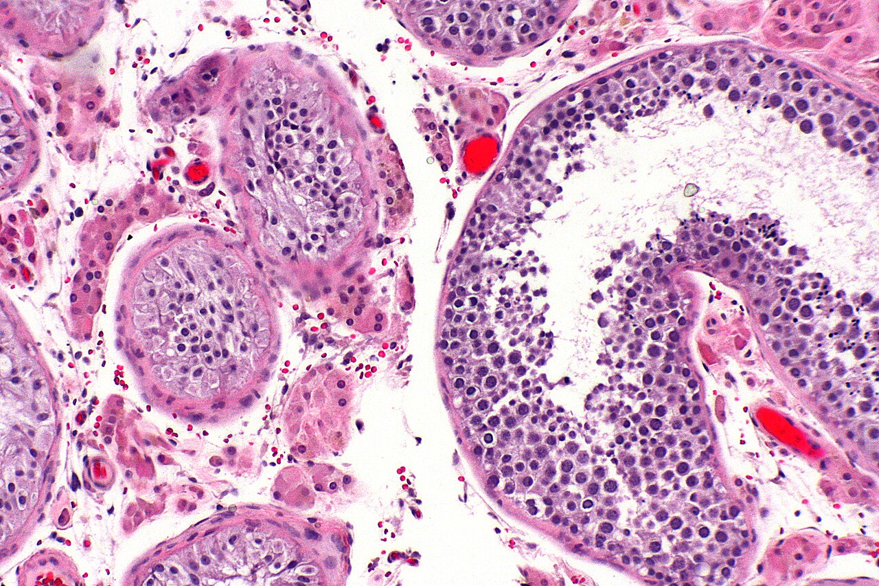 TRT Testicular Atrophy & Infertility: What Men Need to Know